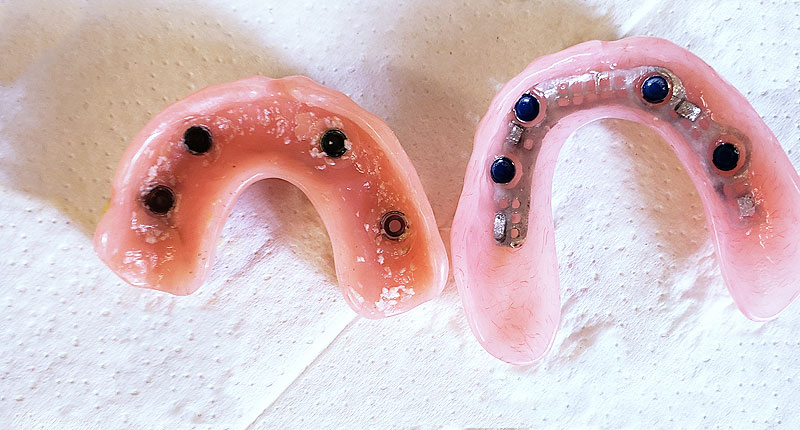 Showing denture mounts on removable dentures