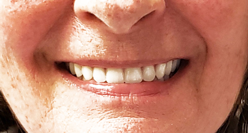 Close up of smile with full dentures