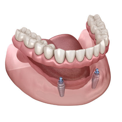 Illustration of removable dentures on implants